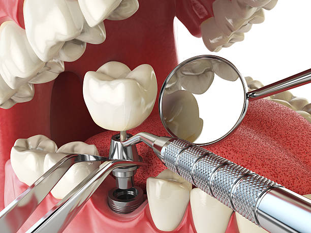 Best Emergency Denture Repair in Upland, CA